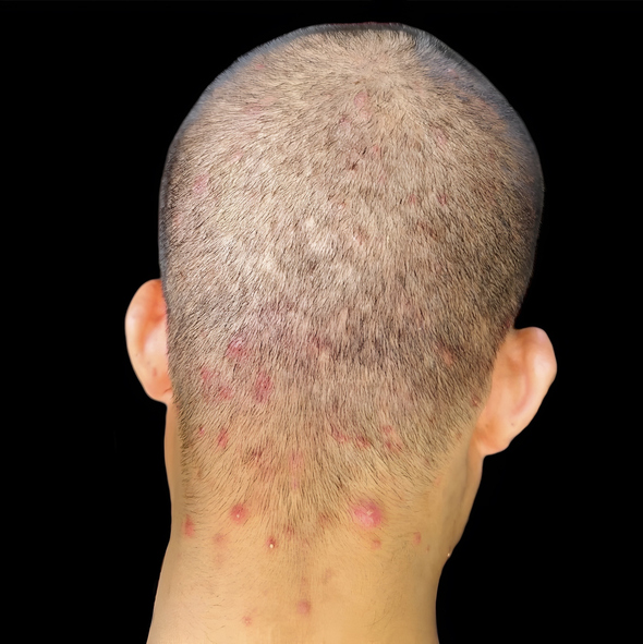 Acne Keloidalis Nuchae — dermatology condition treated at Uplift Wellness & Aesthetics