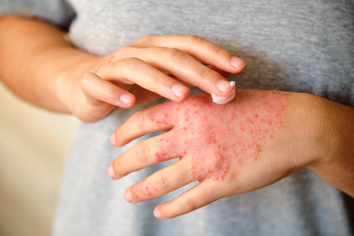 Atopic Dermatitis (Eczema) — dermatology condition treated at Uplift Wellness & Aesthetics