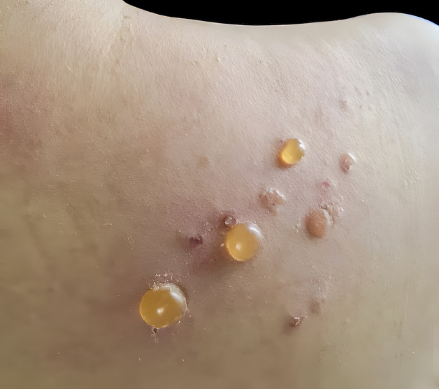 Bullous Pemphigoid — dermatology condition treated at Uplift Wellness & Aesthetics