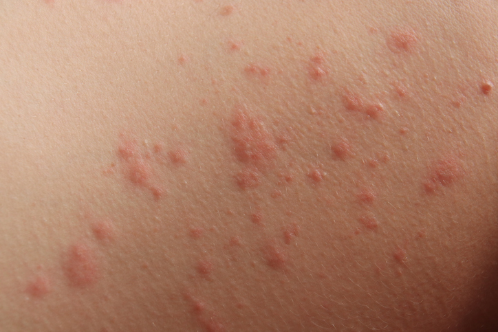 Contact Dermatitis — dermatology condition treated at Uplift Wellness & Aesthetics