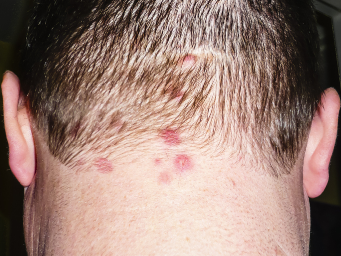 Dermatitis Herpetiformis — dermatology condition treated at Uplift Wellness & Aesthetics