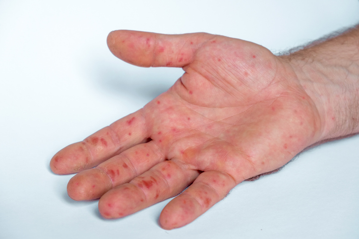 Dermatomyositis — dermatology condition treated at Uplift Wellness & Aesthetics
