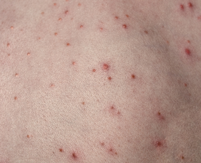 Folliculitis — dermatology condition treated at Uplift Wellness & Aesthetics