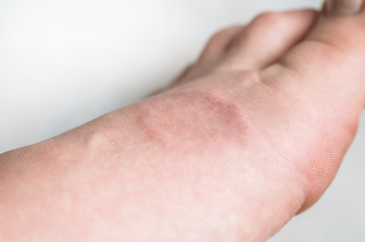 Granuloma Annulare — dermatology condition treated at Uplift Wellness & Aesthetics