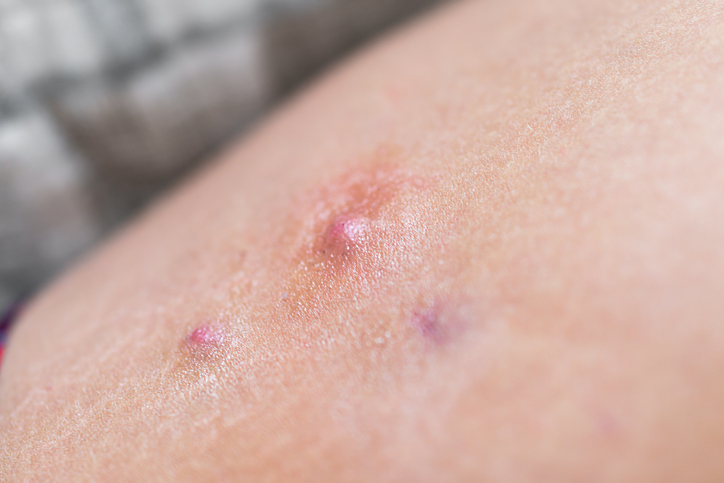 Hidradenitis Suppurativa — dermatology condition treated at Uplift Wellness & Aesthetics