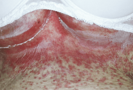 Intertrigo — dermatology condition treated at Uplift Wellness & Aesthetics