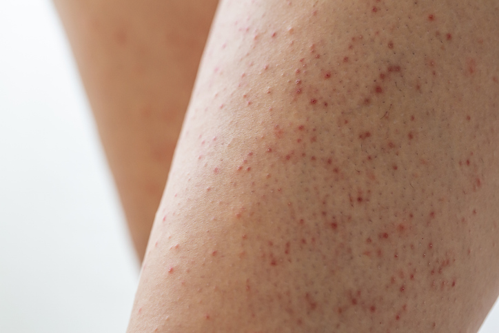 Keratosis Pilaris — dermatology condition treated at Uplift Wellness & Aesthetics