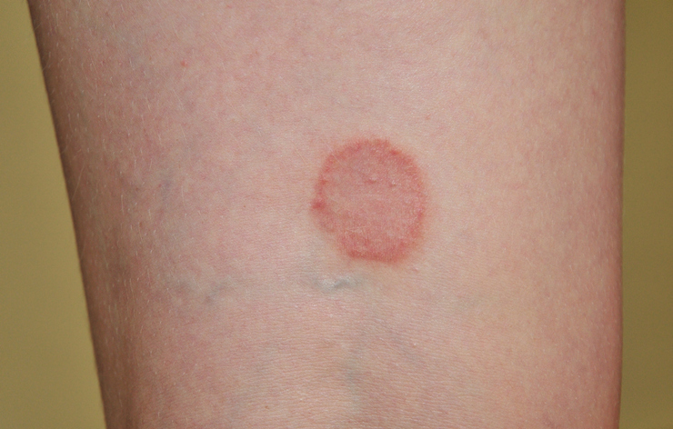 Lichen Planus — dermatology condition treated at Uplift Wellness & Aesthetics