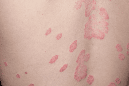 Lichen Sclerosus — dermatology condition treated at Uplift Wellness & Aesthetics