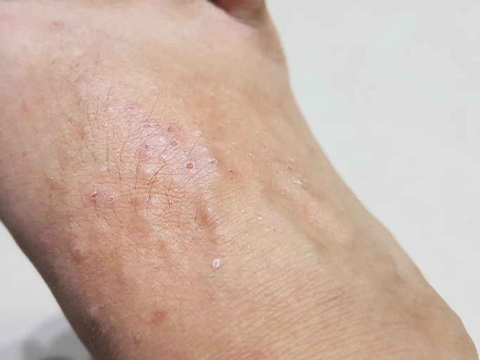 Lichen Simplex Chronicus — dermatology condition treated at Uplift Wellness & Aesthetics