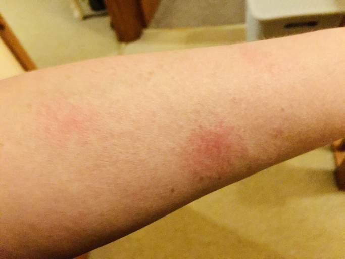 Lupus — dermatology condition treated at Uplift Wellness & Aesthetics