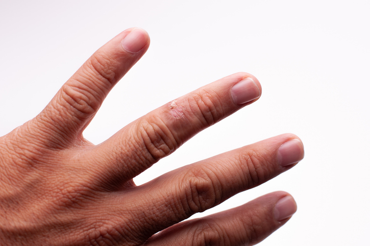 Morphea (Localized Scleroderma) — dermatology condition treated at Uplift Wellness & Aesthetics