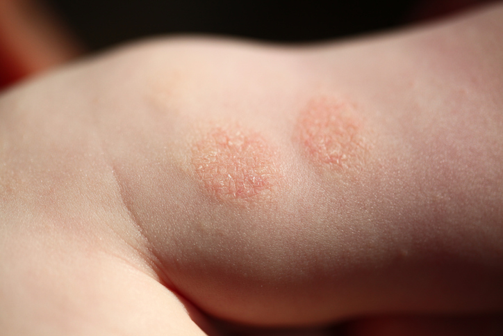Nummular Dermatitis — dermatology condition treated at Uplift Wellness & Aesthetics