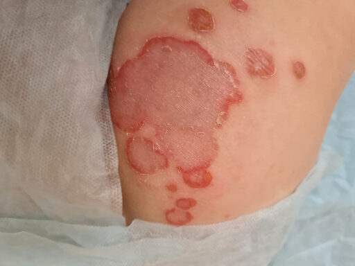 Pemphigus — dermatology condition treated at Uplift Wellness & Aesthetics
