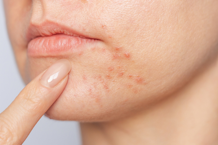 Perioral Dermatitis — dermatology condition treated at Uplift Wellness & Aesthetics