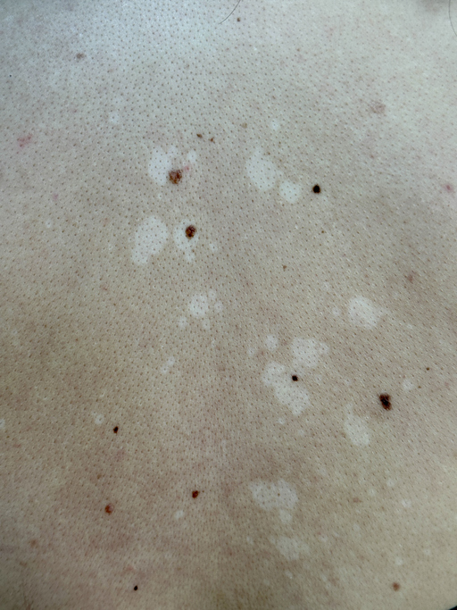 Pityriasis Alba — dermatology condition treated at Uplift Wellness & Aesthetics