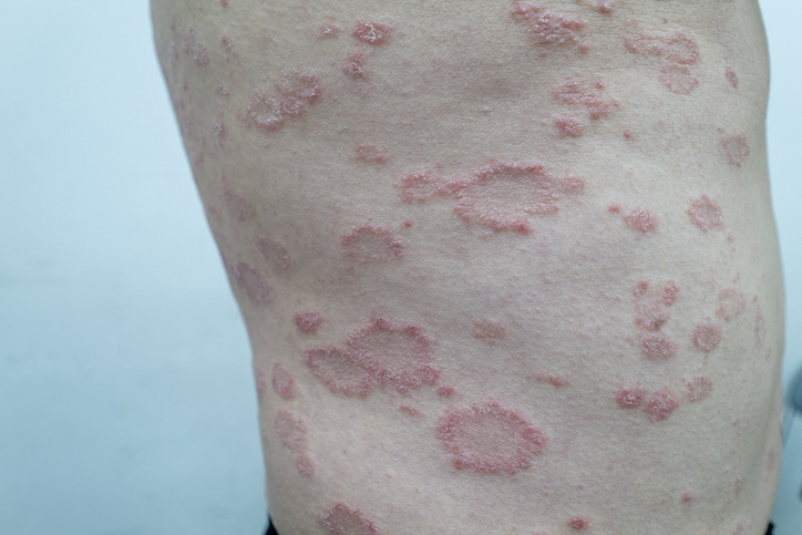 Pityriasis Rosea — dermatology condition treated at Uplift Wellness & Aesthetics