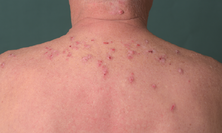 Prurigo Nodularis — dermatology condition treated at Uplift Wellness & Aesthetics