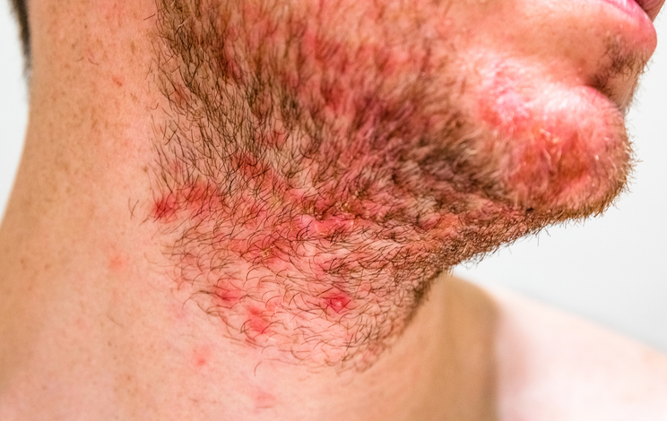 Pseudofolliculitis Barbae — dermatology condition treated at Uplift Wellness & Aesthetics