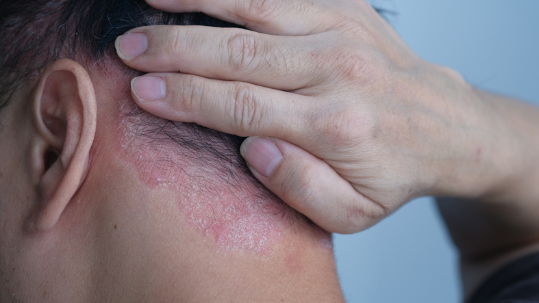 Psoriasis — dermatology condition treated at Uplift Wellness & Aesthetics