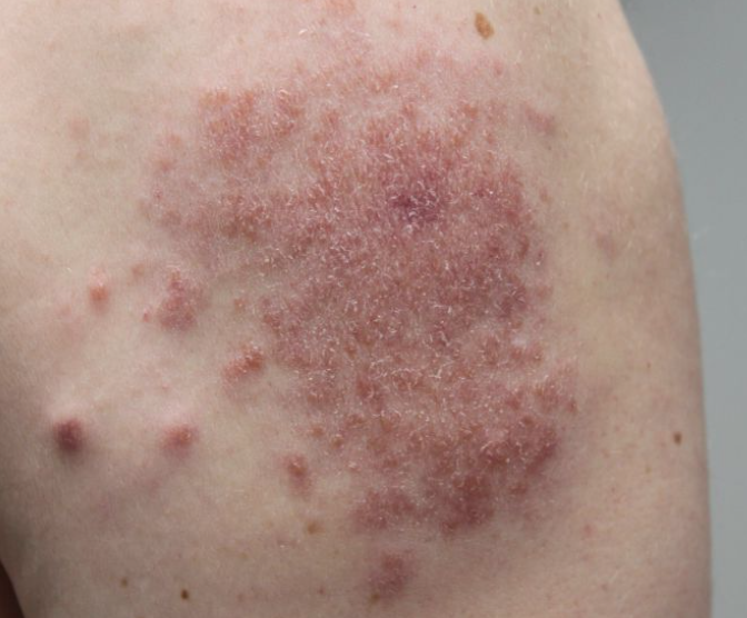 Sarcoidosis — dermatology condition treated at Uplift Wellness & Aesthetics