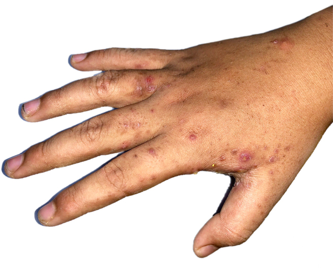 Scabies — dermatology condition treated at Uplift Wellness & Aesthetics