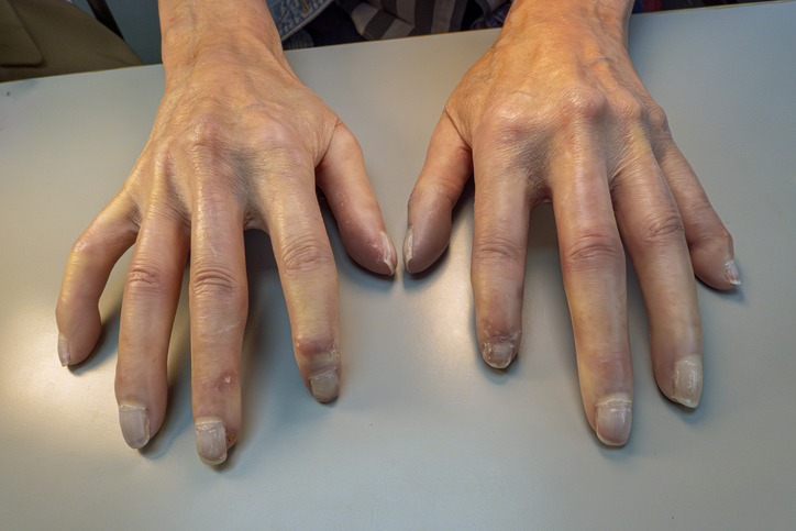 Scleroderma (Systemic Sclerosis) — dermatology condition treated at Uplift Wellness & Aesthetics
