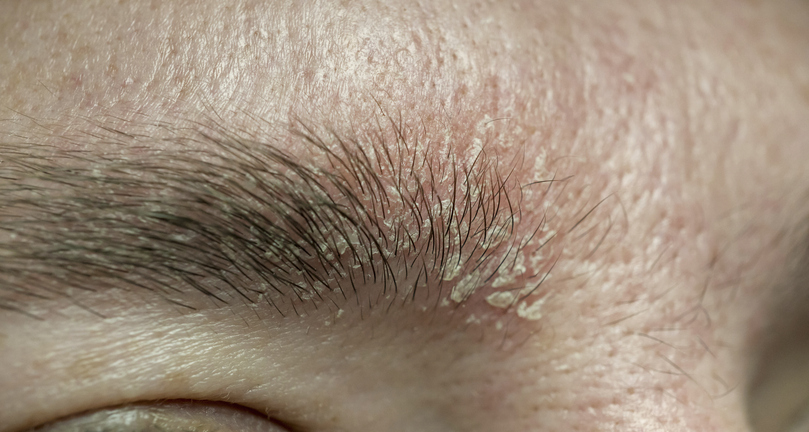 Seborrheic Dermatitis — dermatology condition treated at Uplift Wellness & Aesthetics