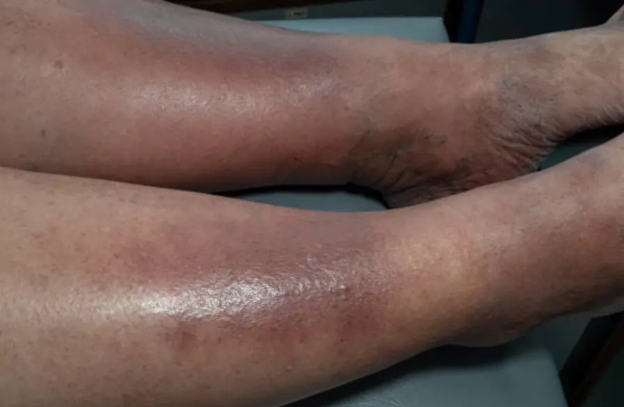 Stasis Dermatitis — dermatology condition treated at Uplift Wellness & Aesthetics