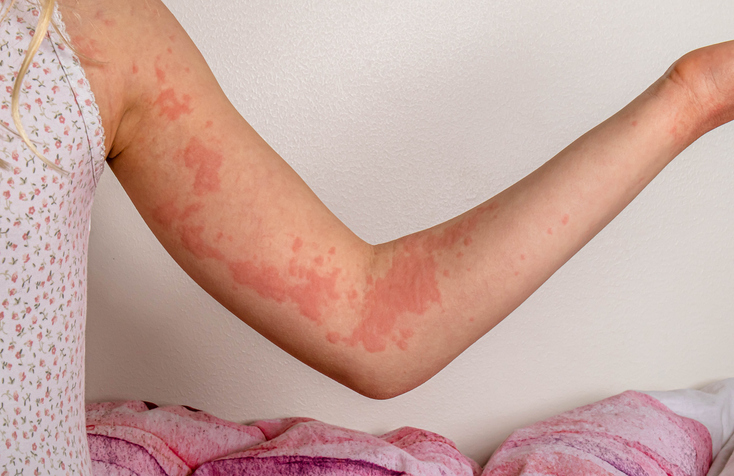 Urticaria (Hives) — dermatology condition treated at Uplift Wellness & Aesthetics