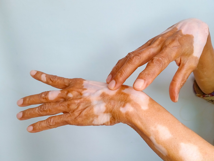 Vitiligo — dermatology condition treated at Uplift Wellness & Aesthetics