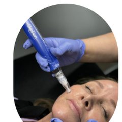 SkinPen microneedling with Platelet Rich Plasma at Uplift Wellness & Aesthetics